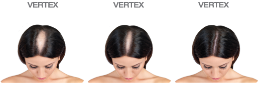 FOLIGAIN Women's Hair Regrowth Kit - FOLIGAIN