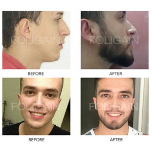 foligain before and after 3