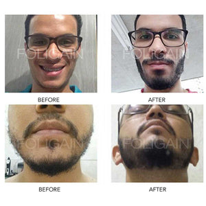 foligain before and after 6