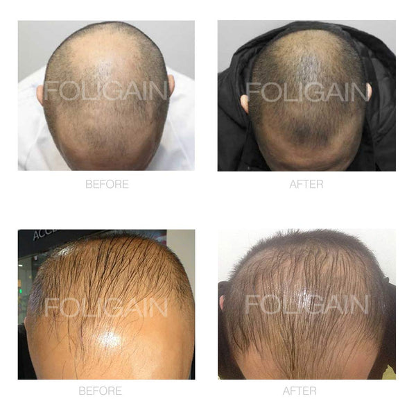 FOLIGAIN Low Alcohol Minoxidil 5% Hair Regrowth Treatment For Men 12 Month Supply - FOLIGAIN