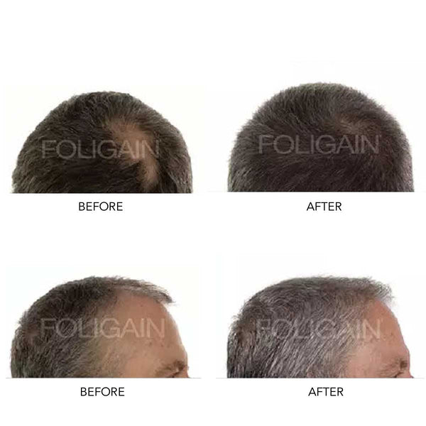 FOLIGAIN Men's Hair Regrowth Kit - FOLIGAIN