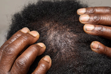 Effective Minoxidil Foam Solutions for Men's Hair Regrowth
