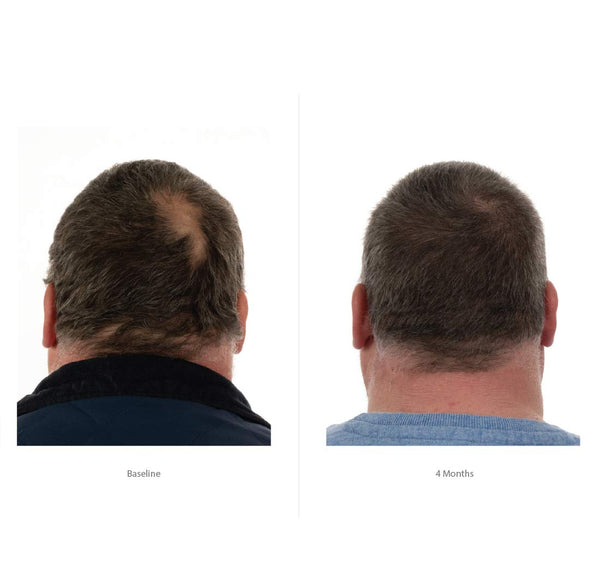 FOLIGAIN Triple Action Complete Formula For Thinning Hair For Men 10% Trioxidil - FOLIGAIN