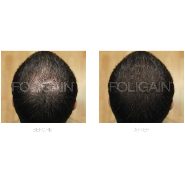 FOLIGAIN Low Alcohol Minoxidil 5% Hair Regrowth Treatment For Men - FOLIGAIN