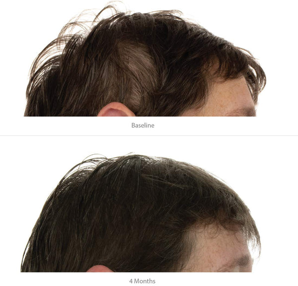 FOLIGAIN Advanced Hair Regrowth Hair Shampoo Minoxidil 2% - FOLIGAIN