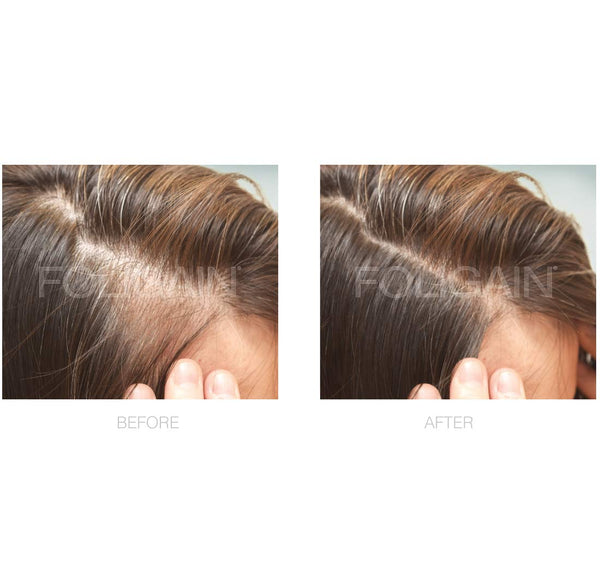FOLIGAIN Minoxidil 2% Hair Regrowth Treatment For Women - FOLIGAIN